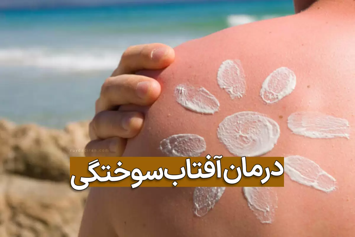 20 روش سریع و کارای درمان خانگی آفتاب سوختگی صورت و بدن