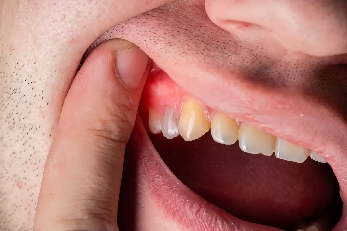 پژوهشگران ژاپنی و دارویی برای رشد دوباره دندان‌ها در انسان!