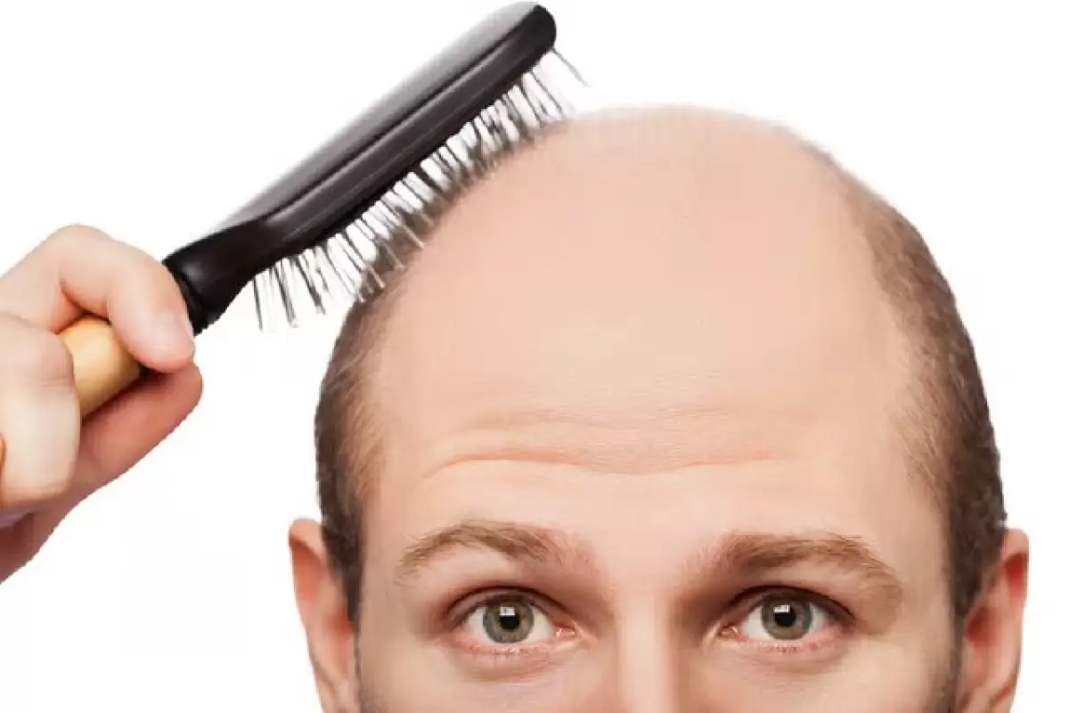 عامل اصلی ریزش موهای مردان شناسایی شد