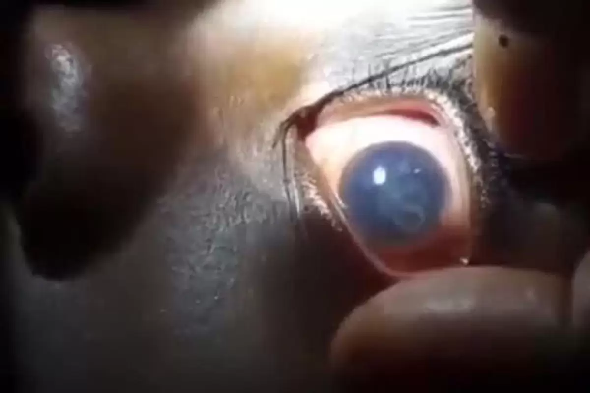 ( ویدیو) بیماری وحشتناک کرم چشم در آفریقا!