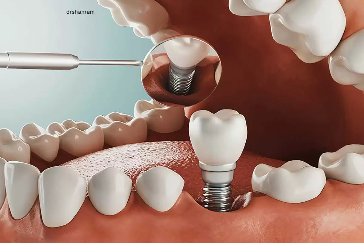 هزینه ایمپلنت دندان چقدر است و چه مزایا و معایبی دارد؟
