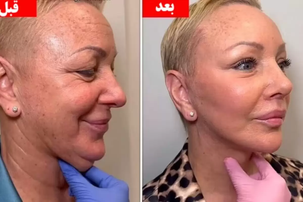 (ویدئو) این زن ۶۰ ساله پس از عمل زیبایی ۳۰ سال جوان تر شد و همه را شگفت‌زده کرد