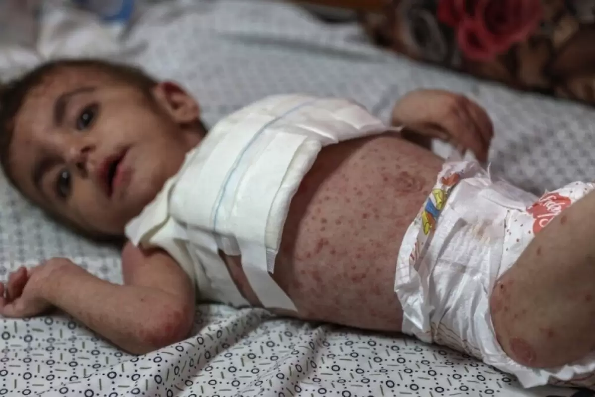 (ویدئو) شیوع بیماری‌های پوستی بین کودکان در غزه