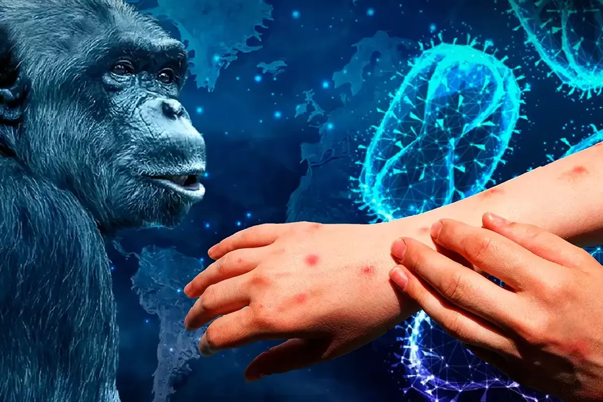 هشدار مهم وزارت بهداشت درباره جهش ژنی و سرعت شیوع آبله میمونی جدید