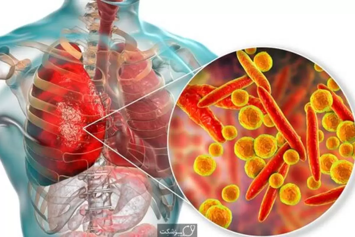 ببینید | اگر ذات الریه این علائم را داشته باشد خطرناک است؛ آنرا جدی بگیرید!