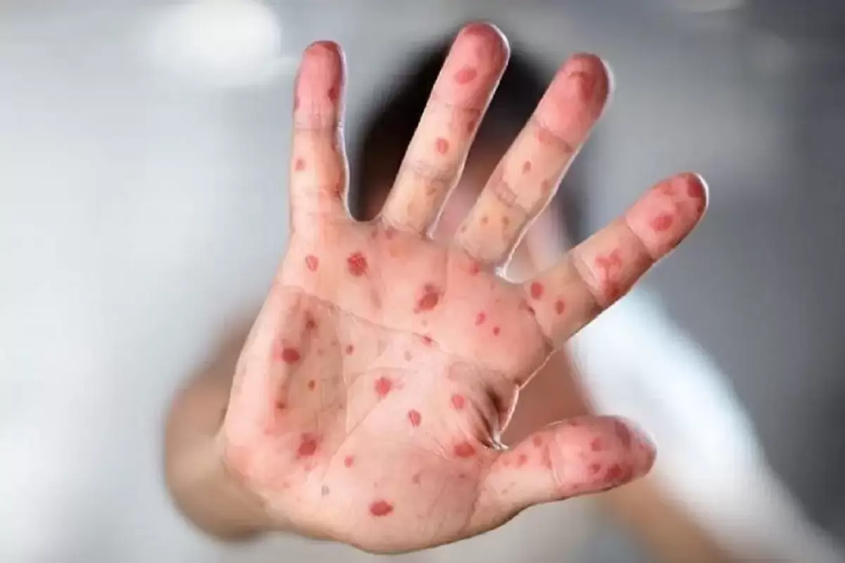 موارد ابتلا به سرخک در آمریکا به حدود ۹۰۰ تن رسید