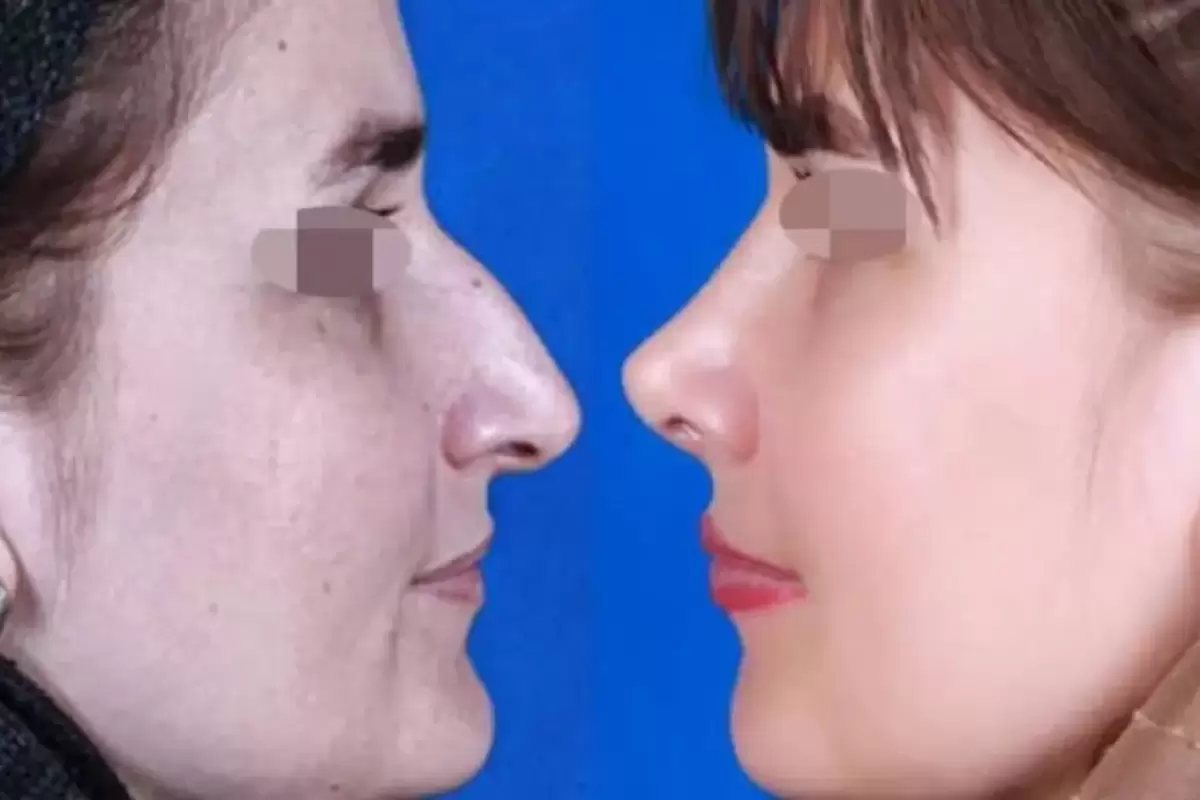 جراحی بینی امسال چند درمی‌آید؟