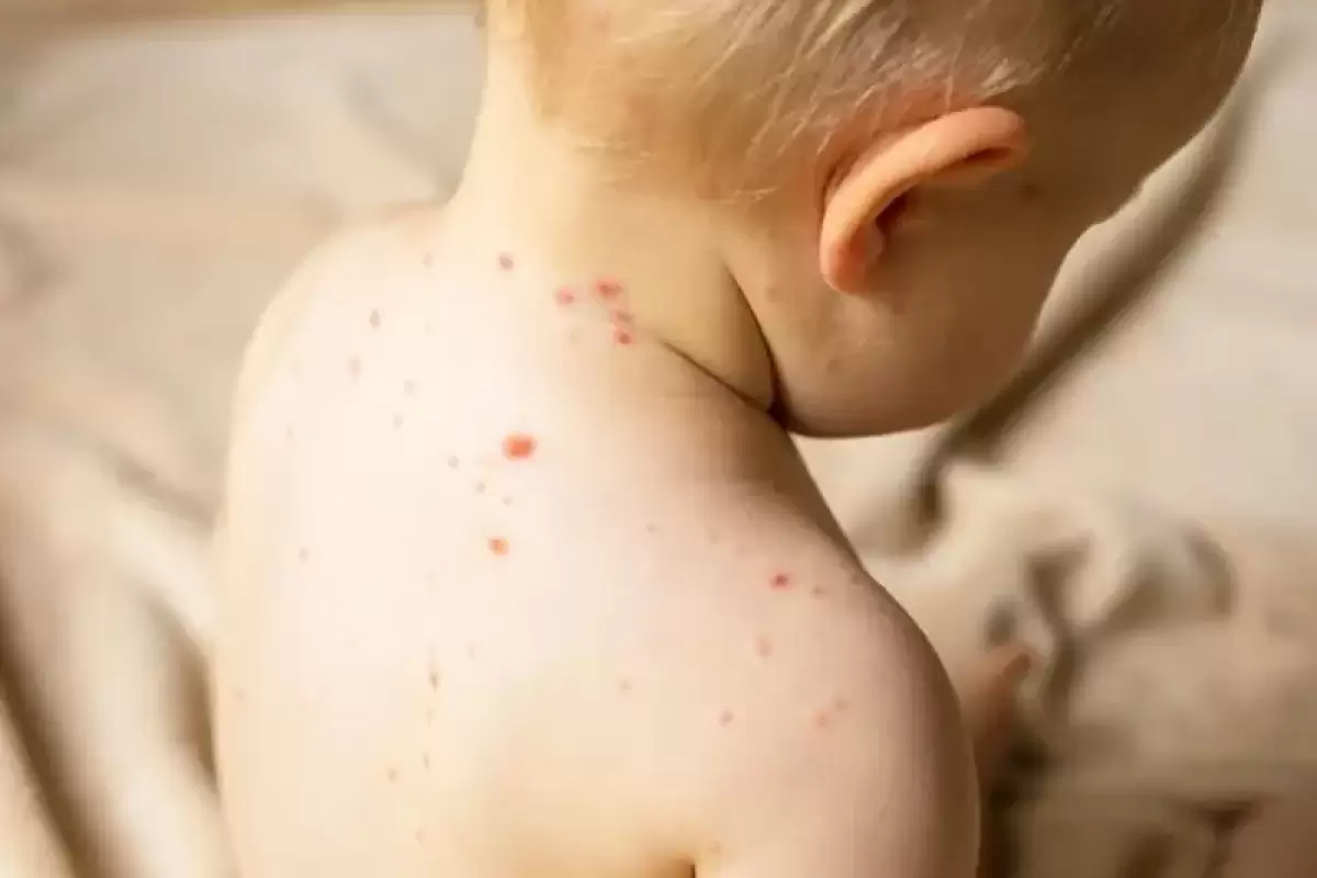 شناسایی ۶۷۴ ابتلا به سرخک