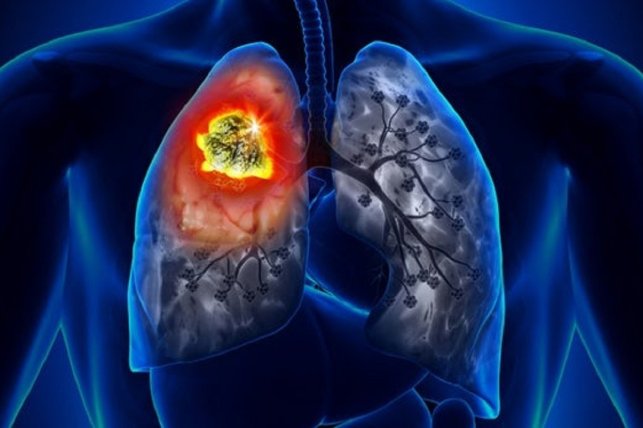 مهمترین نشانه سرطان ریه را بشناسید
