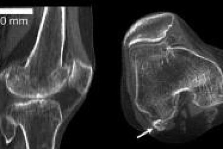 مشاهده استخوان منسوخ شده دوباره در بدن انسان