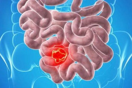 عوامل خطر بروز سرطان روده بزرگ را بشناسیم