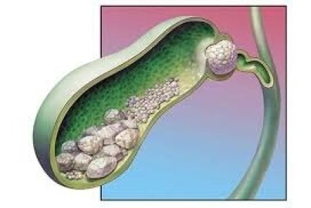 نوشیدنی که از سنگ کیسه صفرا پیشگیری می‌کند