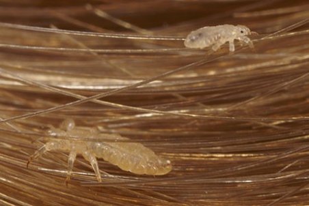 این علائم ثابت می‌کند شما شپش دارید! + روش های درمان