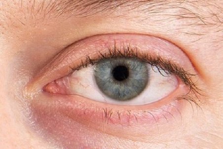 چه کسانی در معرض ابتلا به خشکی چشم هستند؟