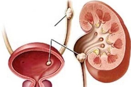 علت ابتلا به سنگ مثانه چیست؟