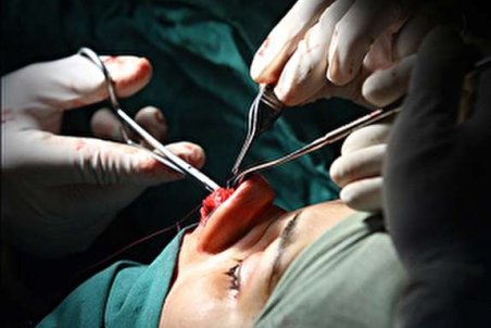 شایع‌ترین جراحی زیبایی در ایران/ حداقل و حداکثر سن برای انجام جراحی بینی