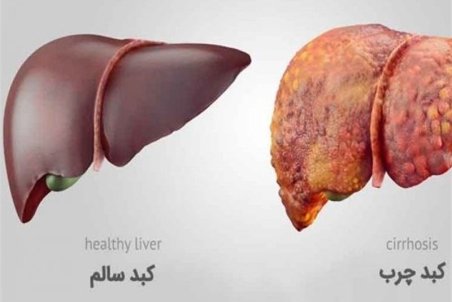 "کبد چرب" خود را با این روش به راحتی آب خوردن درمان کنید!