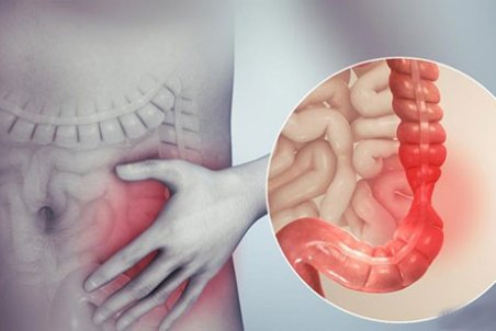 سندرم روده‌ی تحریک‌پذیر؛ علت‌ها، علائم و راهکار‌های خانگی