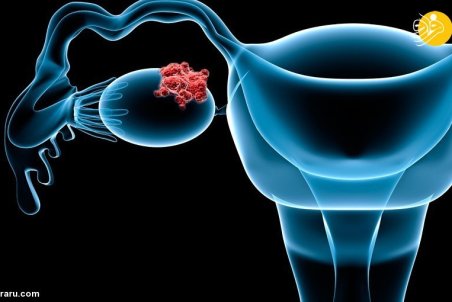 سرطان تخمدان و ۱۰ باور نادرست که باید بدانید و اصلاح کنید!