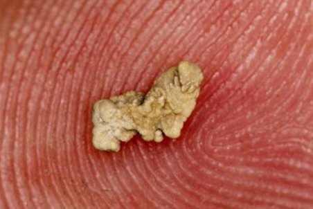 چند راهکار ساده برای دفع سریع "سنگ کلیه"