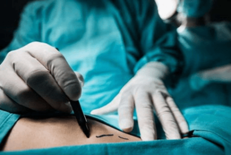 جراحی زیبایی برداشتن ناف چه عوارضی دارد؟