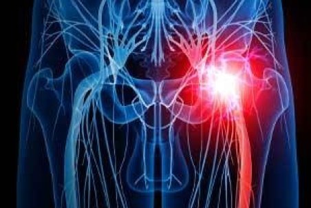 درد سیاتیک چیست؟ + علت و درمان