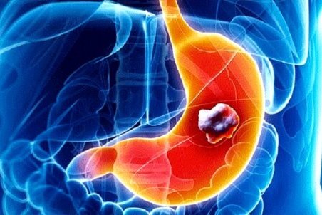 فلج معده چیست؟