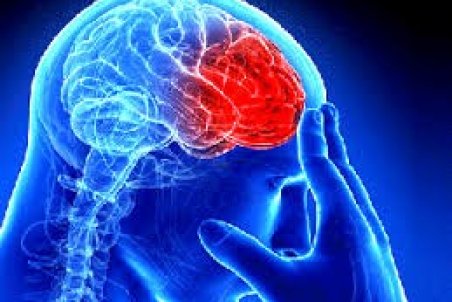 مردم علائم سکته مغزی را جدی بگیرند