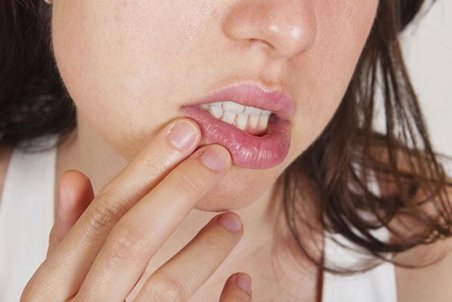 آفتوژل (Aftogel)، اولین داروی موثر در درمان آفت دهان