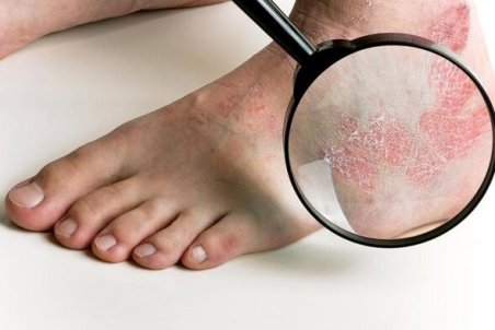 پسوریازیس نباید با اگزما اشتباه گرفته شود
