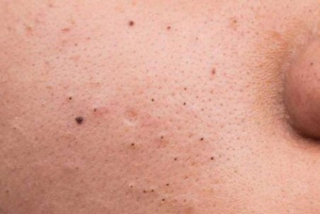 چگونه جوش‌های سرسیاه را از بین ببریم؟