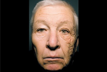 اثبات درمان سرطان پوست با نوعی ویروس