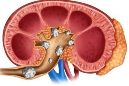 بهترین روش خانگی برای دفع سنگ کلیه