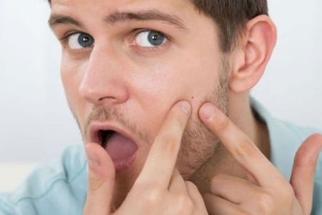 آکنه را سه سوته درمان کنید