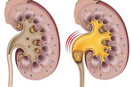 5 علامت هشدار دهنده سنگ کلیه که باید به خاطر بسپاریم