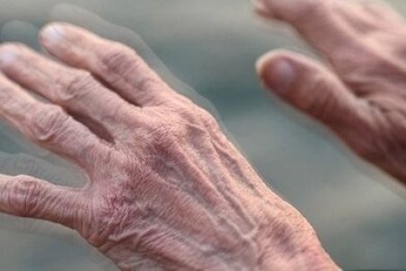 مهمترین علت ابتلا به «پارکینسون» چیست؟