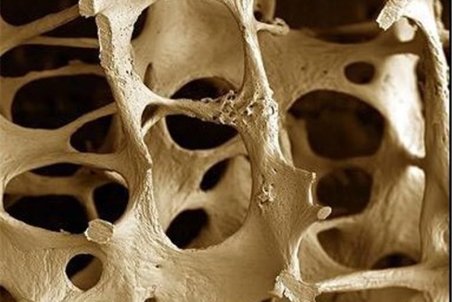 "پوکی استخوان" خود را با این ۱۵ دستورالعمل ساده درمان کنید!