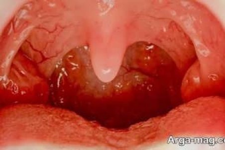 درمان عفونت گلو با انواع راهکارهای خانگ