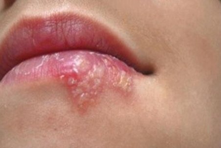 چگونه از بروز تبخال پیشگیری کنیم؟