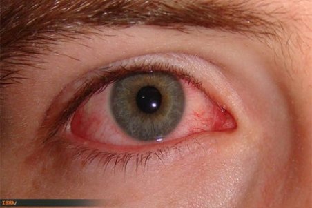 چه افرادی مستعد ابتلا به تیروئید چشمی هستند؟