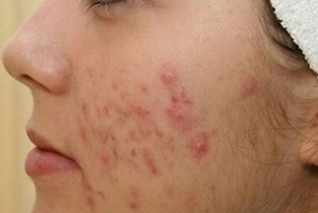 جای جوش را چگونه از بین ببریم؟