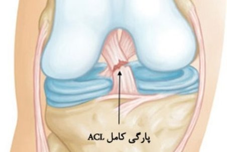 تمرینات توانبخشی پس از جراحی رباط صلیبی + عکس