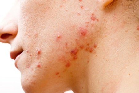 پردنیزولون چیست؟ آیا پردنیزولون باعث ایجاد جوش صورت و بدن می‌شود؟