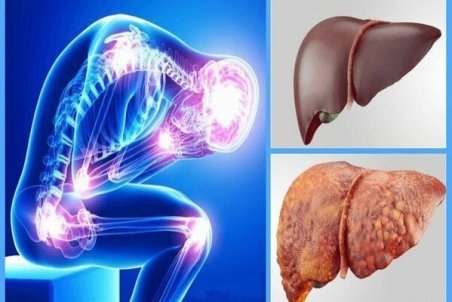 شیرینی‌ها عامل کبد چرب هستند نه چربی‌ها!