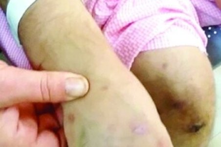 رد سوختگی بر تن «بیتا»