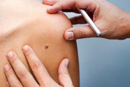 خال‌برداری با لیزر یا جراحی؟