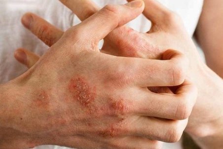 همه آنچه باید درباره اگزما بدانیم