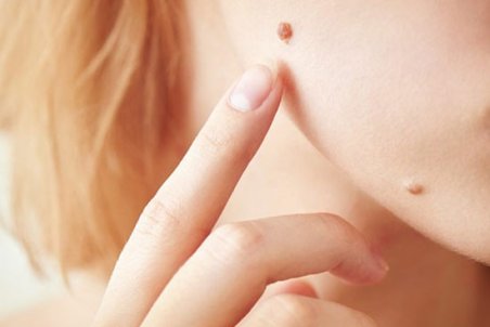 خال خوش‌خیم و بدخیم چه تفاوتی دارند؟