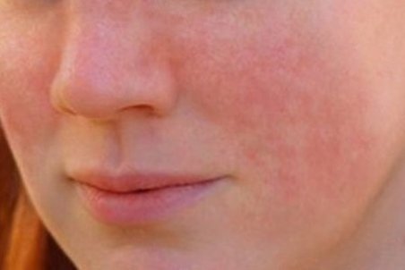 علائم تشخیص لوپوس چیست؟