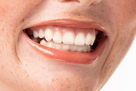 سفید شدن لثه‌ها را جدی بگیرید
